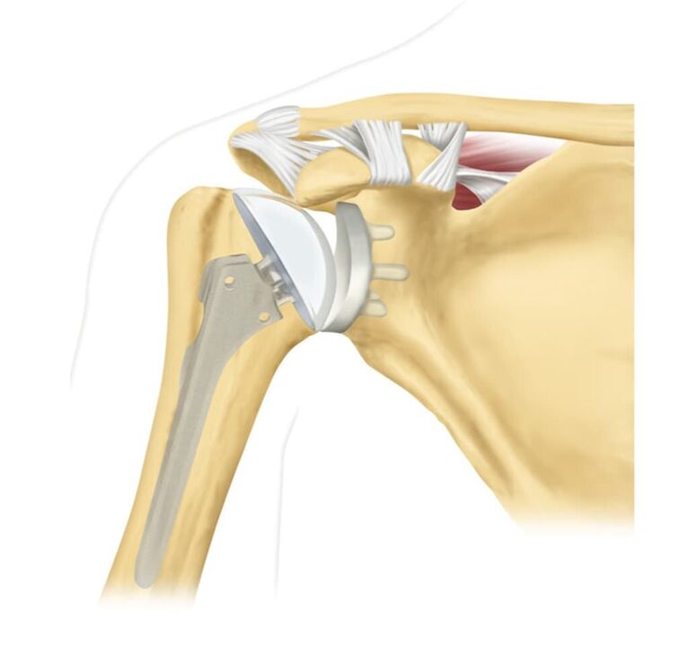 Replacing a damaged shoulder joint with a stent