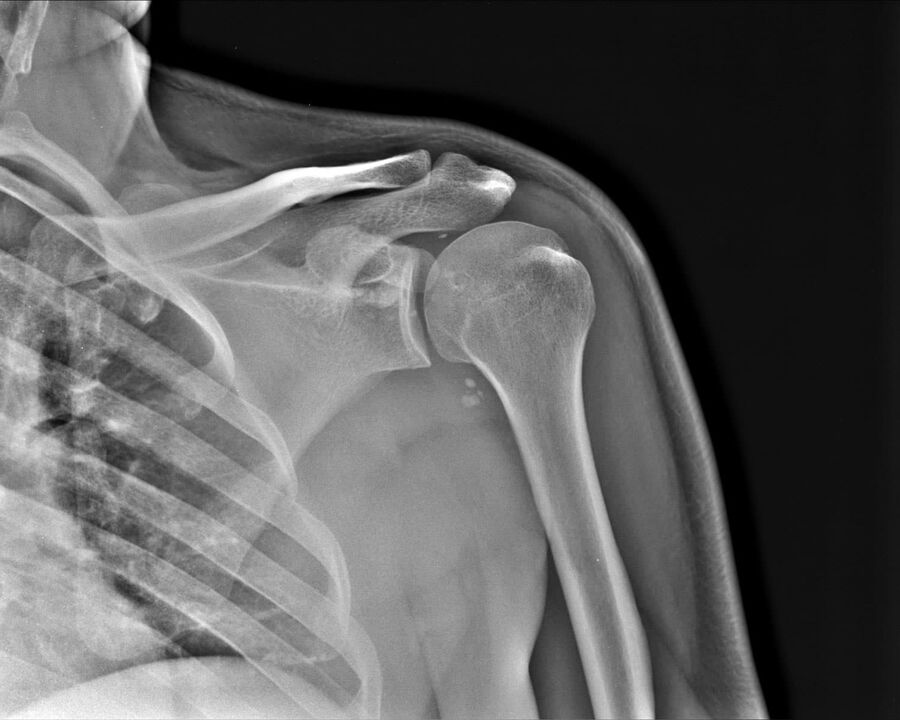 X-ray of osteoarthritis of the shoulder joint of second degree of severity. 
