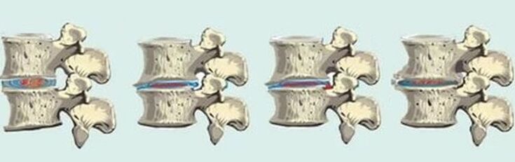 spinal injury in case of thoracic osteochondrosis
