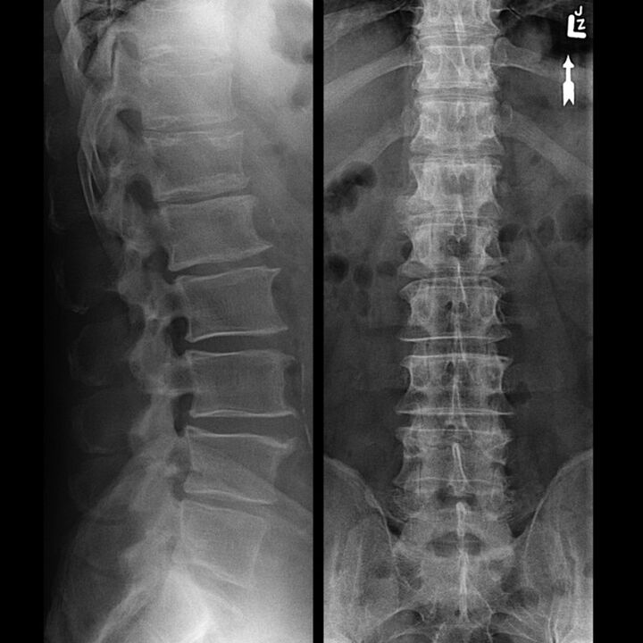 X-ray of the thoracic region, showing a decrease in the space between the vertebrae along the spine from the bottom up. 