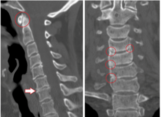 Computed tomography shows damaged vertebrae and discs of heterogeneous height due to thoracic osteochondrosis. 