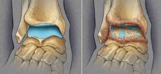 osteoarthritis of healthy joints and ankles