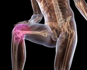 Inflammation of the knee joint with osteoarthritis. 
