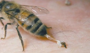 treatment of hip osteoarthritis caused by bees