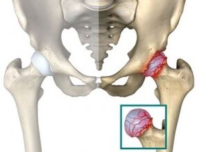 Causes of athrosis of the hip joint.