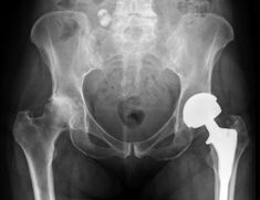 diagnosis of osteoarthritis of the hip joint