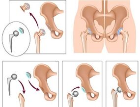 endoprostheses for osteoarthritis of the hip joint