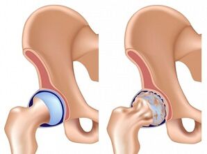 hip osteoarthritis symptoms