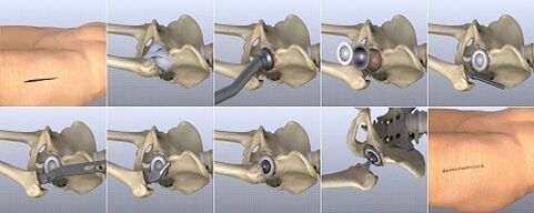 methods to treat hip osteoarthritis